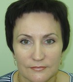 Через месяц после процедуры